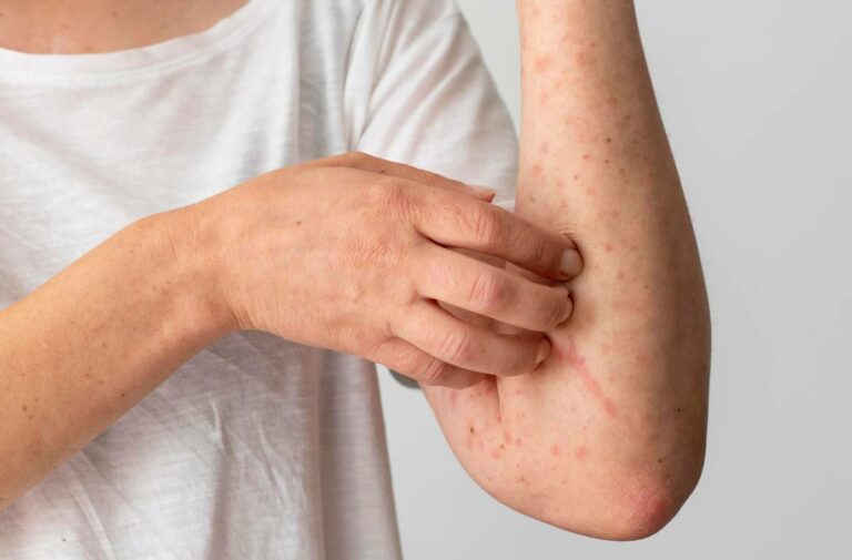 mite textile lyon traitement